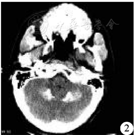 图2ct示双侧小脑齿状核对称性钙化