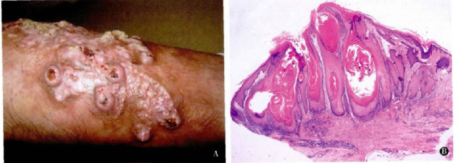 边缘性离心性角化棘皮瘤 1 例