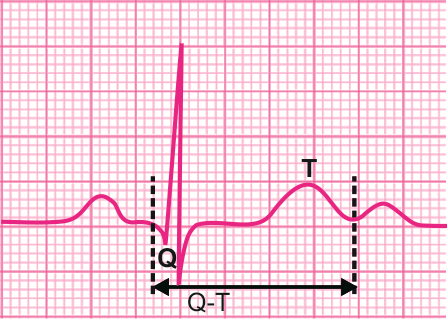 qt间期异常知多少|轻松解读心电图