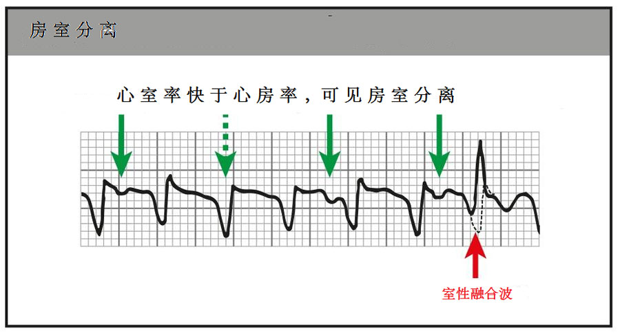 当心电图可以明确发现房室分离,室性融合波以及夺获时,室速的可能性较