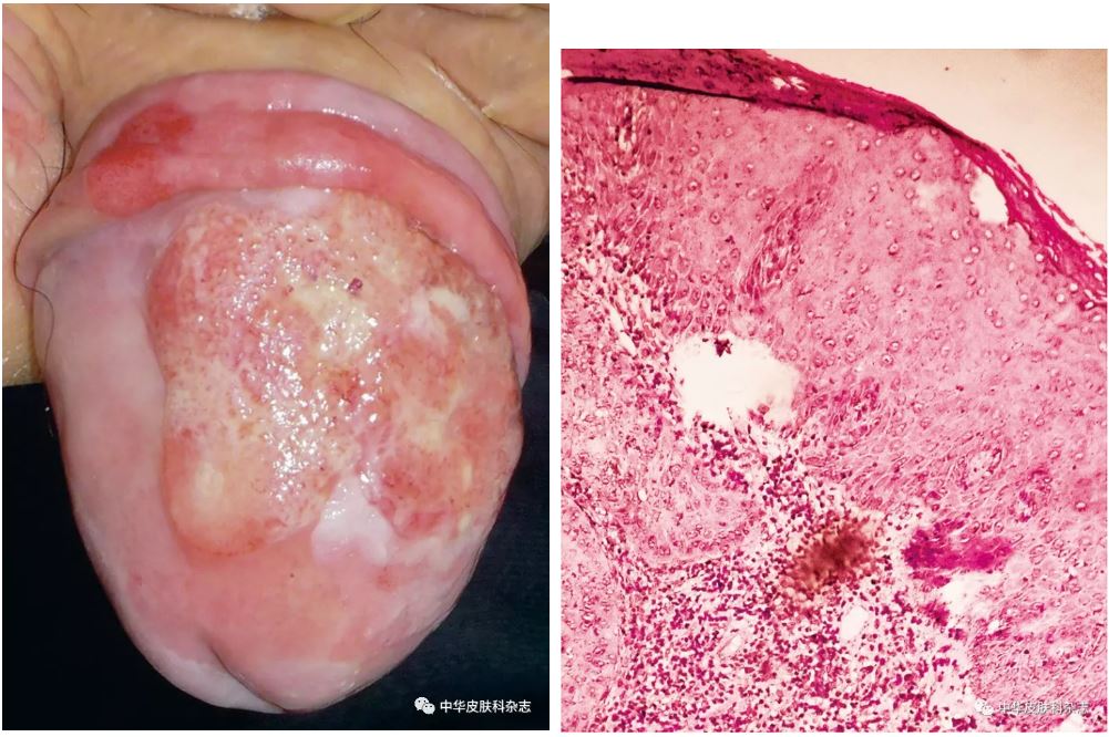人乳头瘤病毒阳性的龟头鳞状上皮细胞癌一例