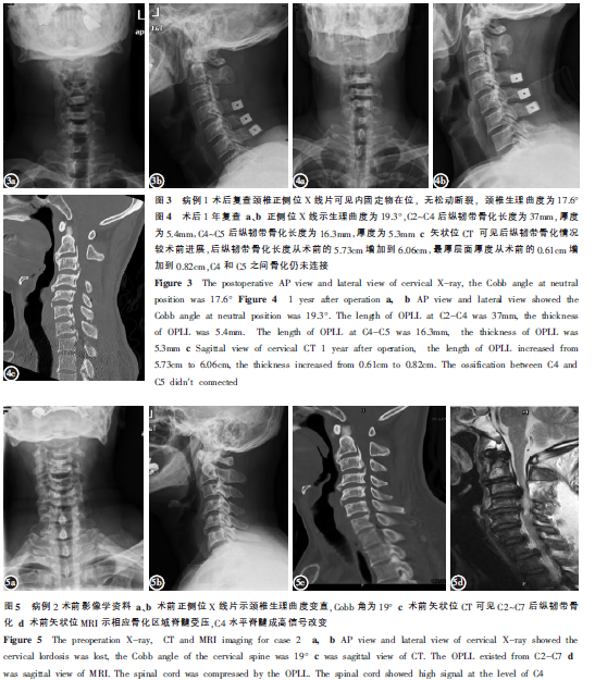 颈椎后纵韧带骨化症术中诱发电位消失2例