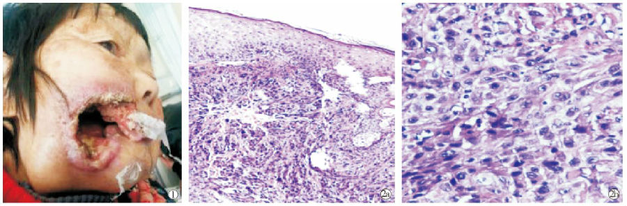 面部溃疡型鳞状细胞癌1 例