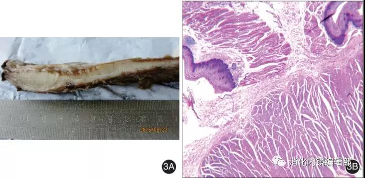 0 cm;3b:显微镜下见食管鳞状上皮下的黏膜肌层及固有肌层肌纤维明显