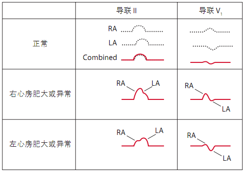 左,右心房肥大时p波在Ⅱ导联和v1导联上的表现