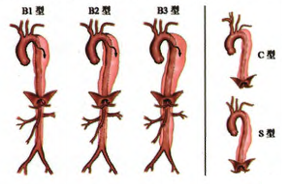 stanford b型主动脉夹层的孙氏细化分型
