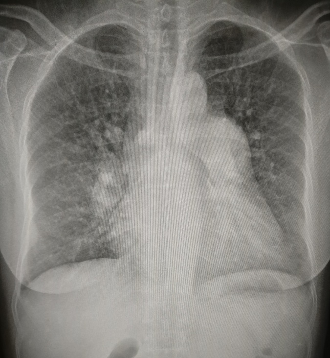 房间隔缺损病人,胸片上见肺纹理增多,增粗,肺血增多,肺动脉段明显