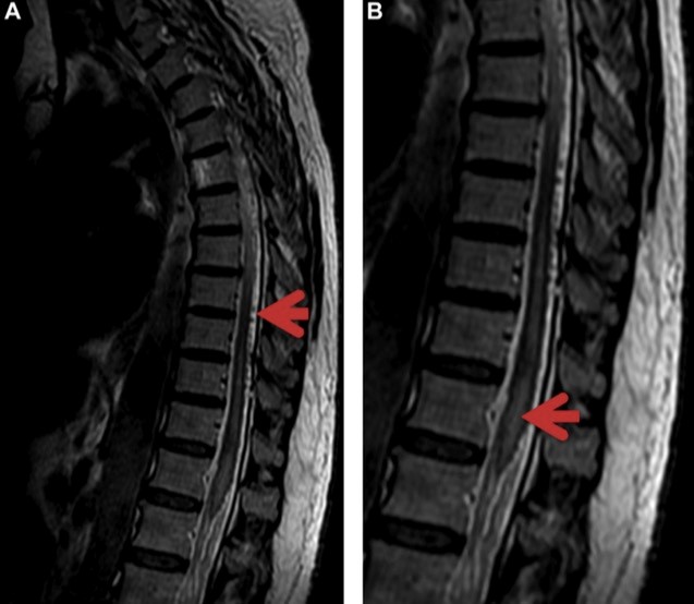 硬脊膜动静脉瘘,你可能漏诊的脊髓损害