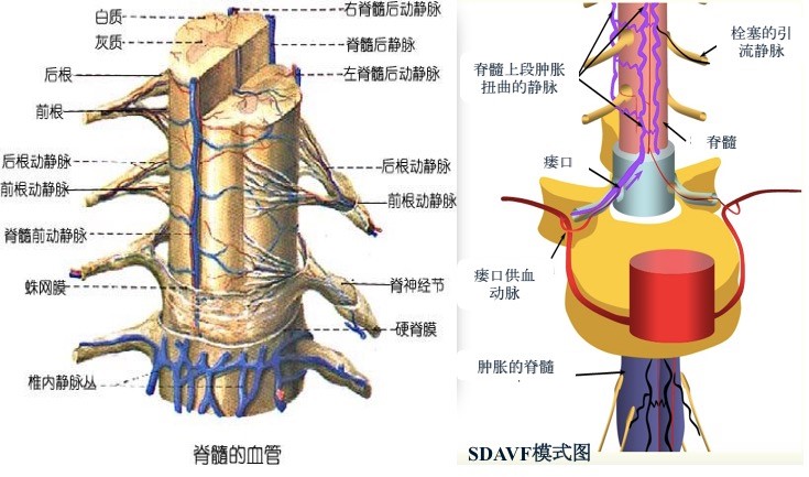 硬脊膜动静脉瘘,你可能漏诊的脊髓损害