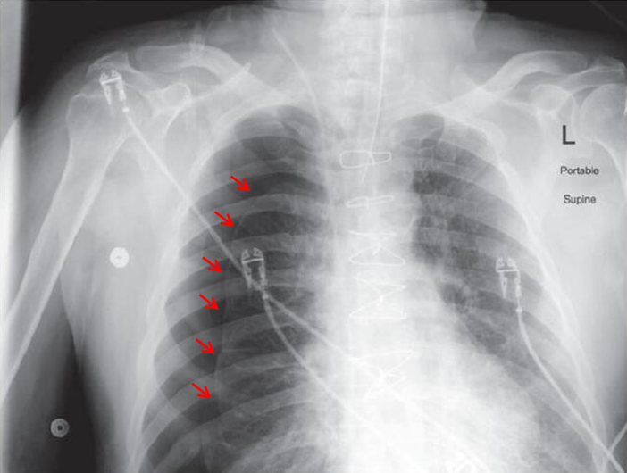 床旁胸片提示右侧大量气胸,红色箭头指示气胸线