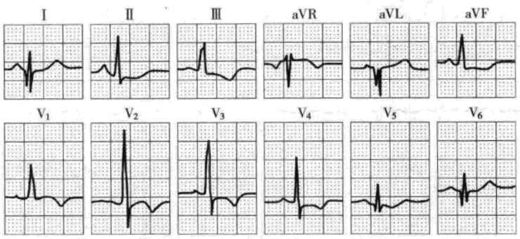 43岁男性,因胸痛描记心电图显示病理性q波,考虑诊断为心肌梗死.