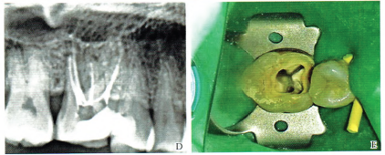上颌第一磨牙双腭根双根管2例