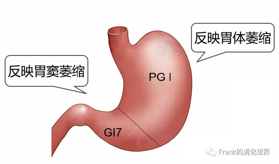 "抽血了解胃癌风险"——血清胃蛋白酶原检测靠谱吗?