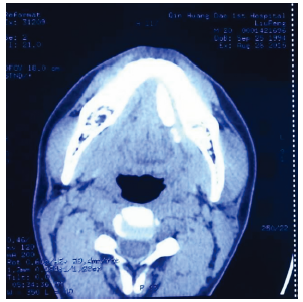 巨大颌下腺导管涎石1例报告