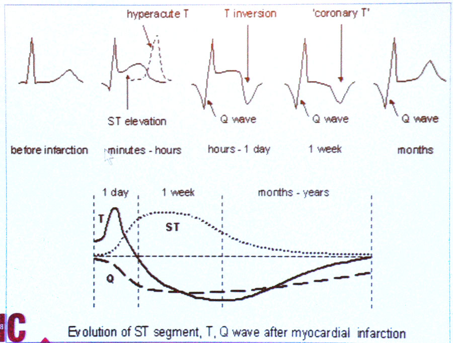 病理性q波可长期存在或发生改变或全部消失(数月至数年 st段多为