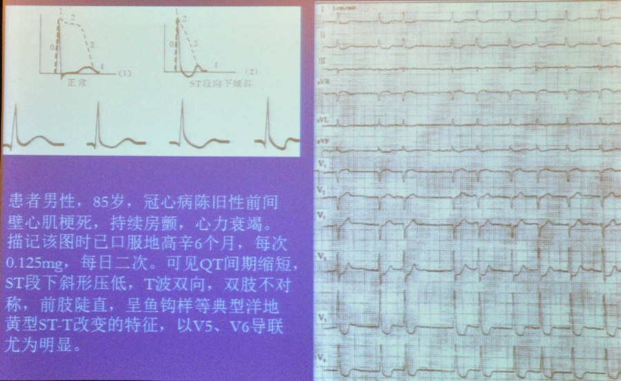 方丕华教授:图解心电图波形和心律分析步骤