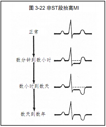图文详解心肌缺血和梗死的心电图