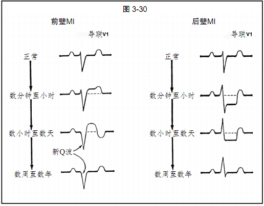 图文详解心肌缺血和梗死的心电图