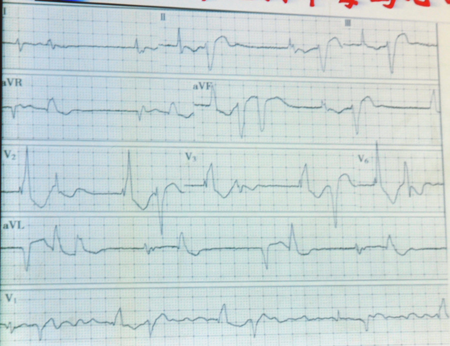 洋地黄中毒患者的心电图:基础心律为房颤,服用地高辛后出现多形性