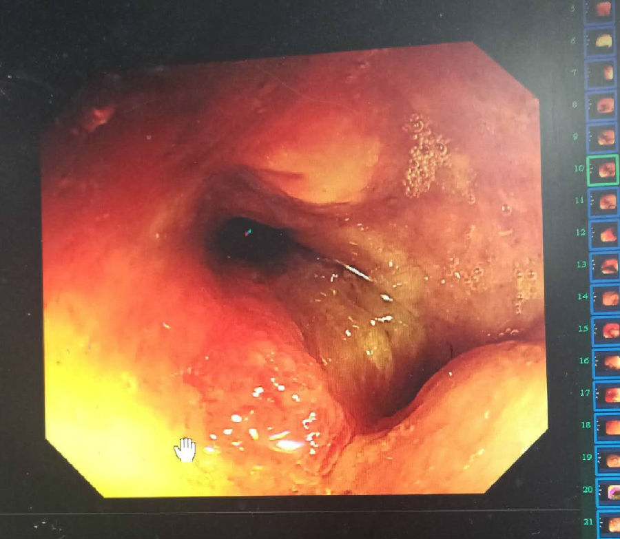 病理:(距肛10cm)管状腺瘤性息肉,伴上皮轻-中度异型增生;(横结肠)破碎