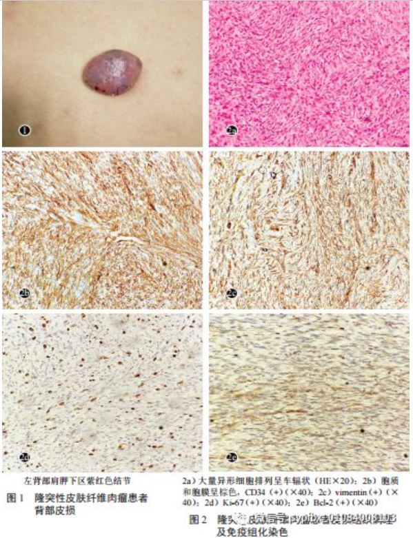 隆突性皮肤纤维肉瘤30例临床分析