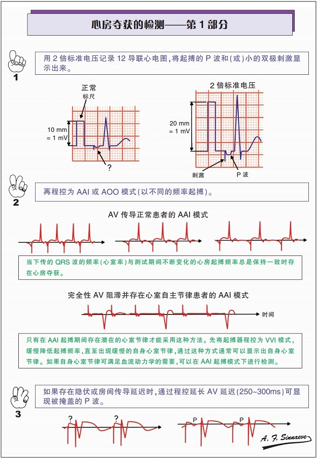 图文并茂 | 关于心房夺获,你了解多少?