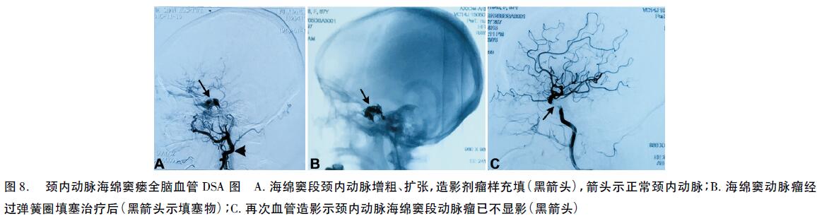 外伤性及医源性:外伤可导致海绵窦瘘及其他脑神经损害;蝶窦内镜