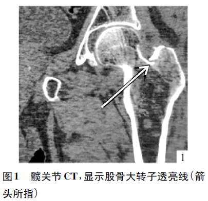 结果与临床表现不相符或高度怀疑髋部骨折时,应完善髋关节ct或mri检查