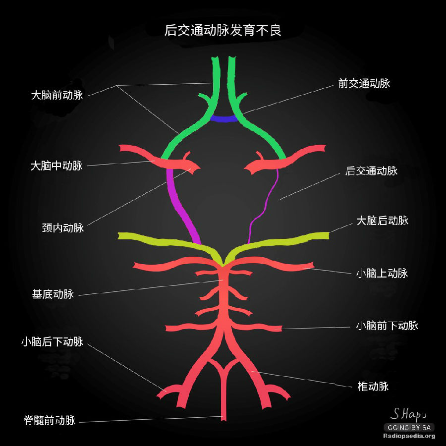 医学资讯 详细 图2 图3 图4 图5 图6 真实世界中willis环变异的mr血管