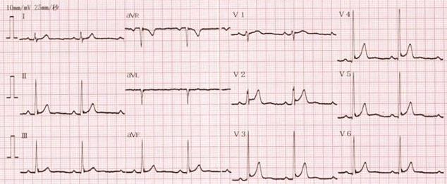 早复极的心电图具有特征性的st段改变,即st段凹面向上伴有j点凹迹.