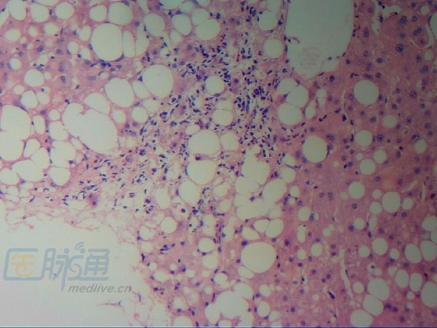 he染色:大泡性为主的肝细胞脂肪变,混合型细胞炎症