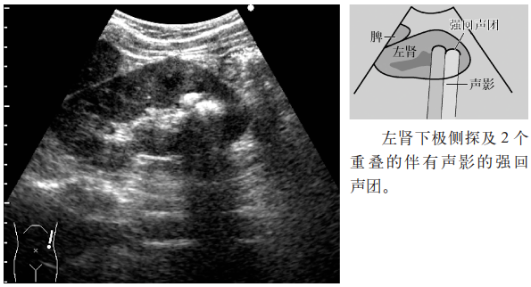 肾结石输尿管结石超声表现一览临床实战