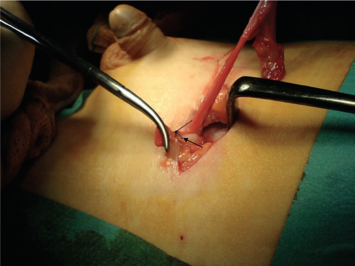 小儿腹股沟睾丸固定术 | 手术图解