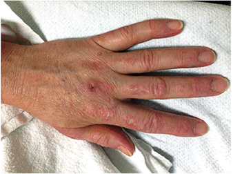 掌指关节和指间关节伸面出现紫红色丘疹,斑(gottron丘疹)