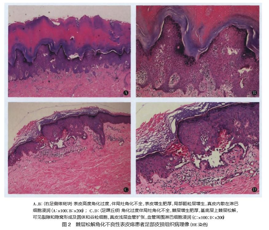 棘层松解角化不良性表皮痣 1 例