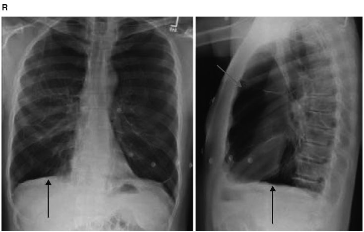 肺实质减少图4-9 ct显示右肺上叶病变:支气管充气征和大片肺实变图4-8