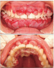 妊娠期多发性牙龈瘤1例