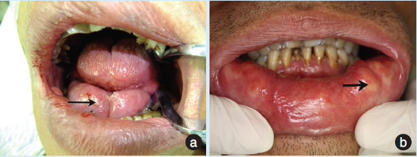 a:口底肿物;b:口腔黏膜的小结节.