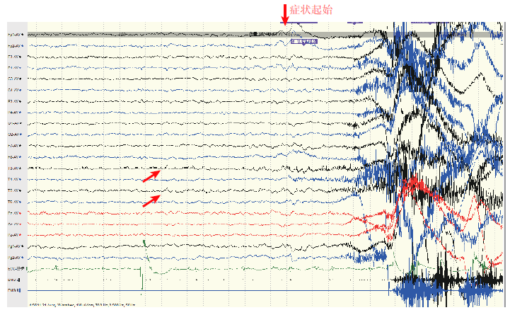 图1 发作期脑电图.发作前3st3,t5少量尖波活动