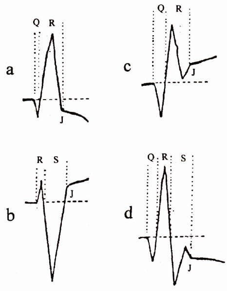 心电图的6个波和3个段|心电3分钟