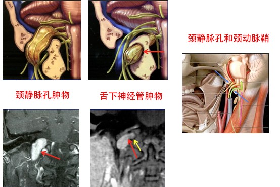 要记的都要看到枕髁-颈静脉孔综合征(collet-sicard syndrome:枕髁