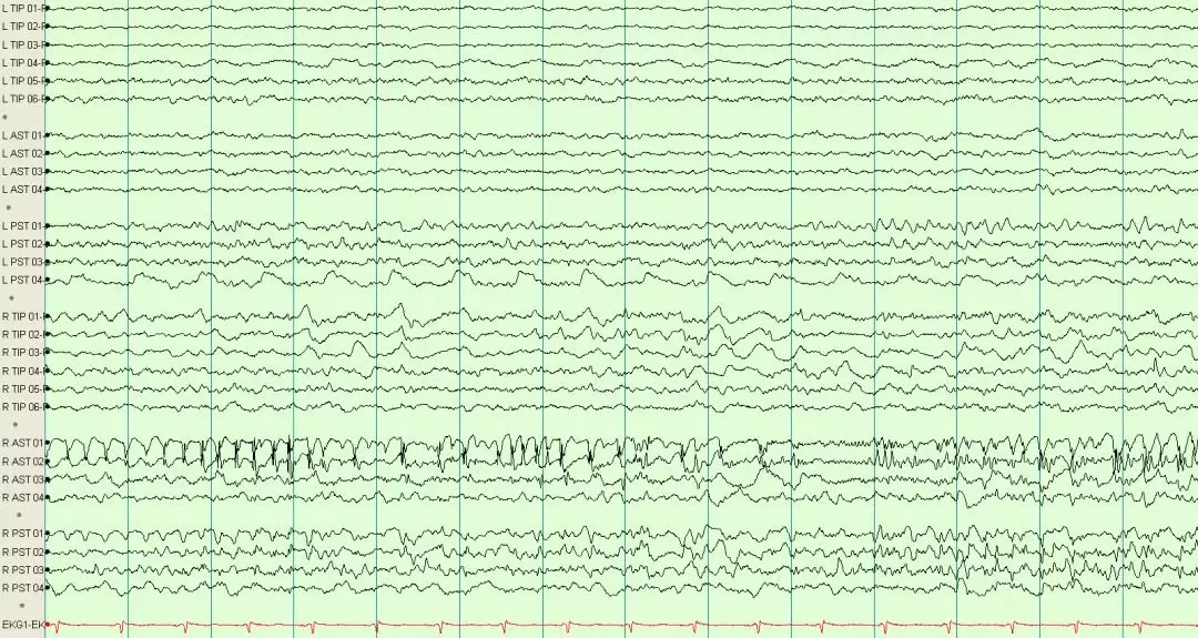 异常篇最一目了然的成人脑电图图谱丨一键收藏