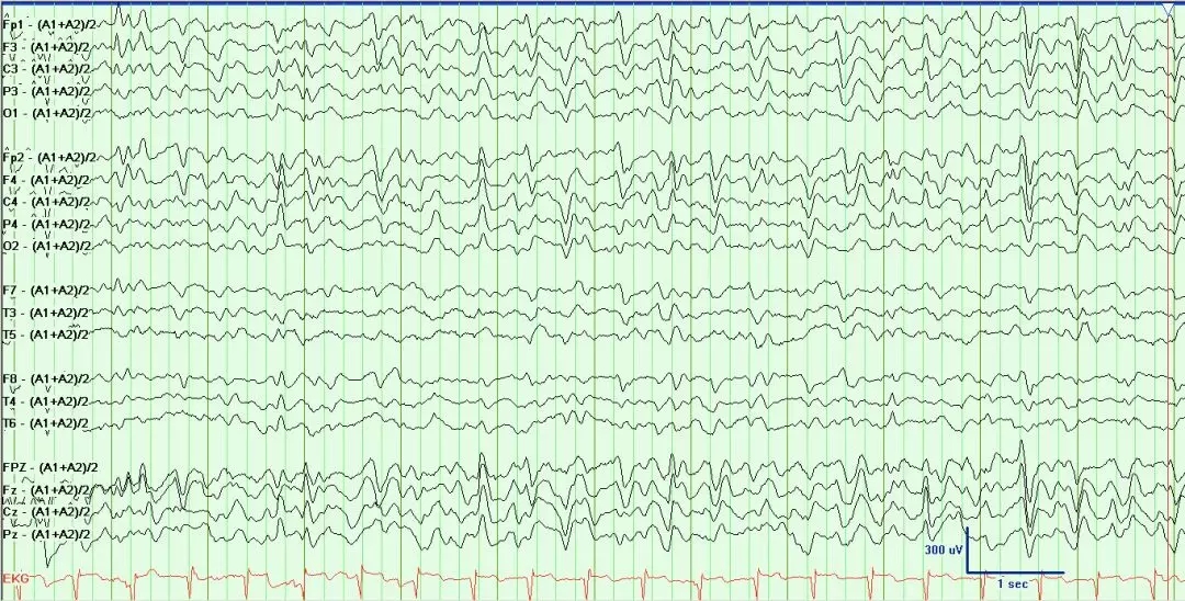 异常篇最一目了然的成人脑电图图谱丨一键收藏