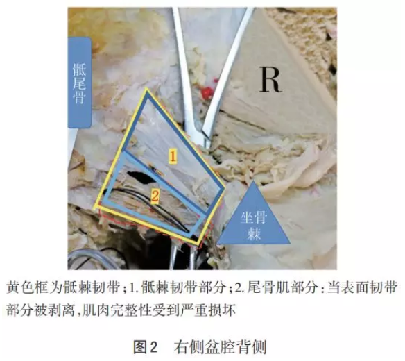 骶棘韧带区域解剖和三维重建研究