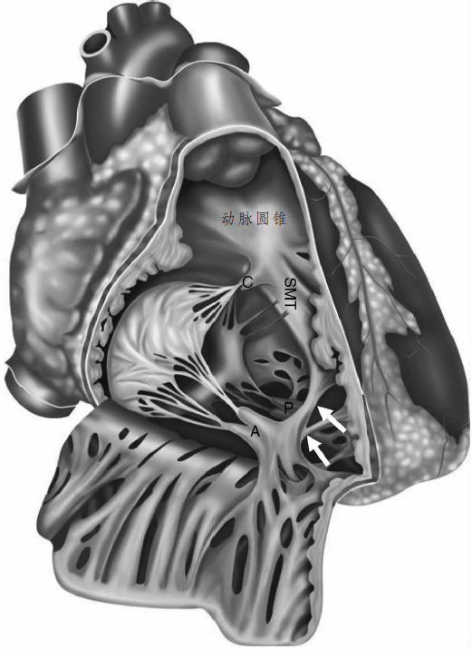 61肺动脉下流出道,又称动脉圆锥或肺动脉漏斗部,是支撑肺动脉瓣叶的