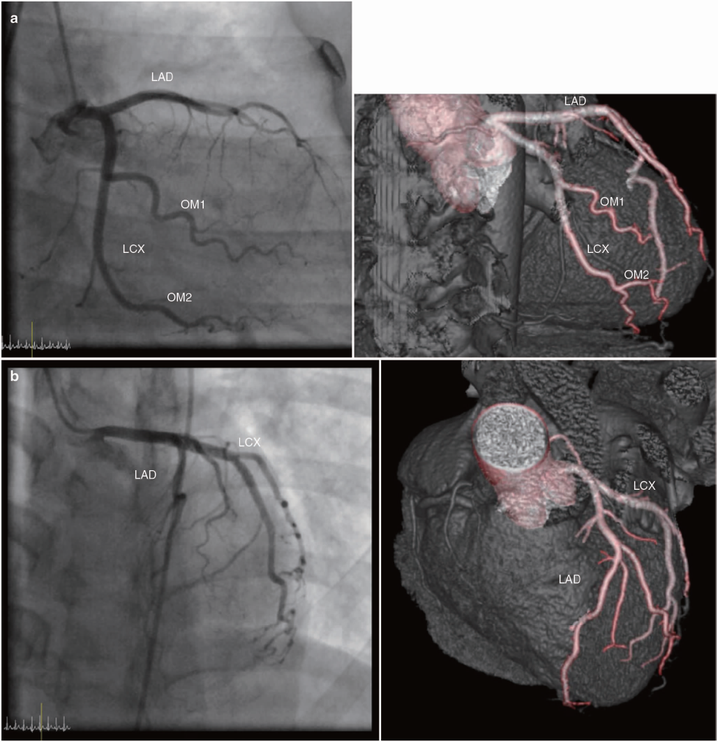 左冠状动脉血管造影血管造影与ct61 右冠状动脉远段:从锐缘支到心脏