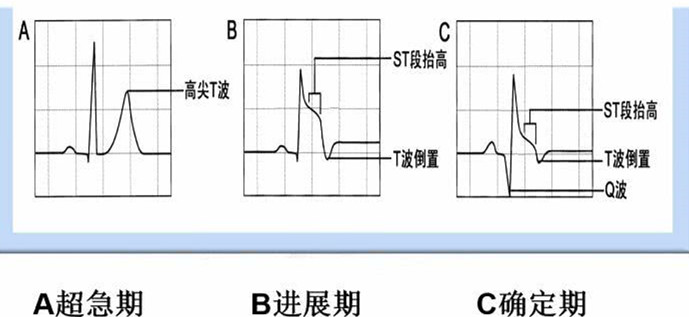 实战中练就火眼金睛acs心电图诊断与病变血管预判心电3分钟