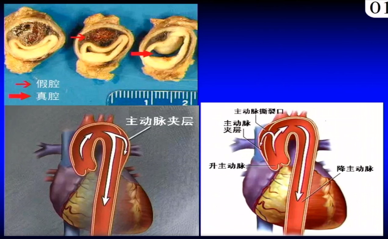 主动脉夹层的病理改变