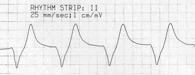 宽qrs波高尖t波不幸的是,此种心电图模式的敏感性不足,心电图相对正常