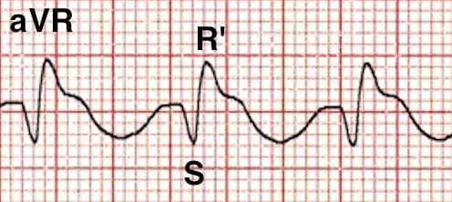 61宽qrs波(120 ms或3个小正方形;61心动过速(约110 bpm,可能是